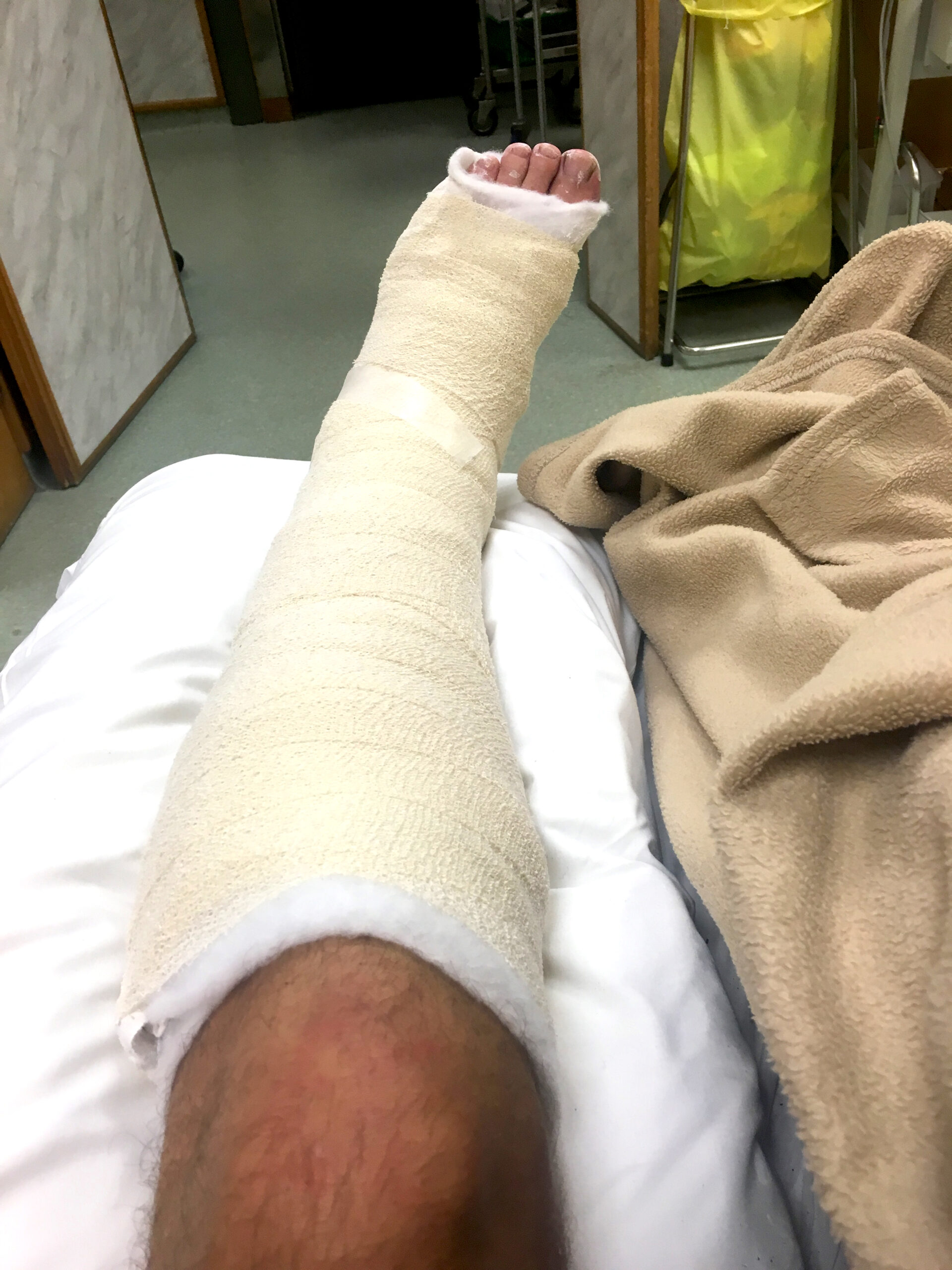 My leg sits in a cast in the hospital in Greymouth, New Zealand.